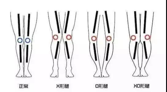 腿型