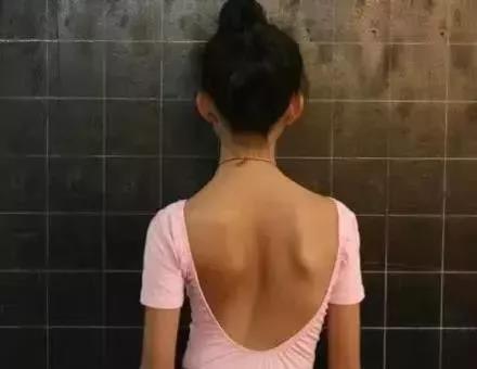 脊椎侧弯